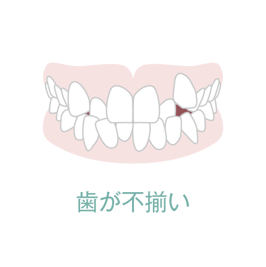 歯が不揃い