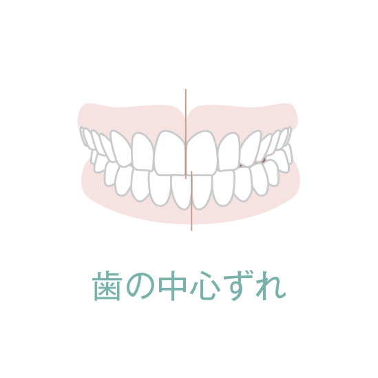 歯の中心ずれ